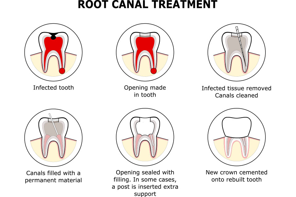 Root Canals