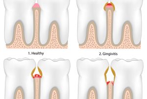 Stages of Gum Disease