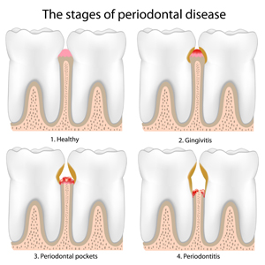 Stages of Gum Disease