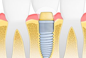 Dental Implant