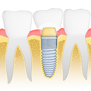 Dental Implant