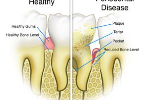 Healthy Teeth VS Perio Disease