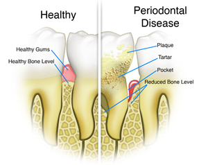 Healthy Teeth VS Perio Disease