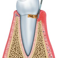 Initial Periodontal Disease