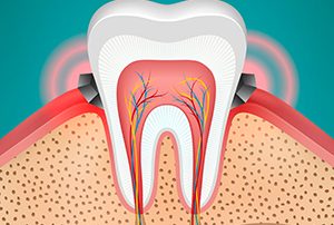 Gingivitis Illustration
